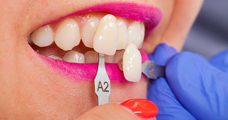 Closeup of a dentist comparing shades of veneers